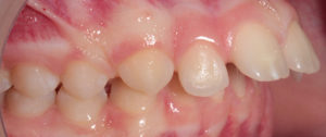 dents avant traitement appareil