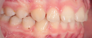 dents après traitement appareil
